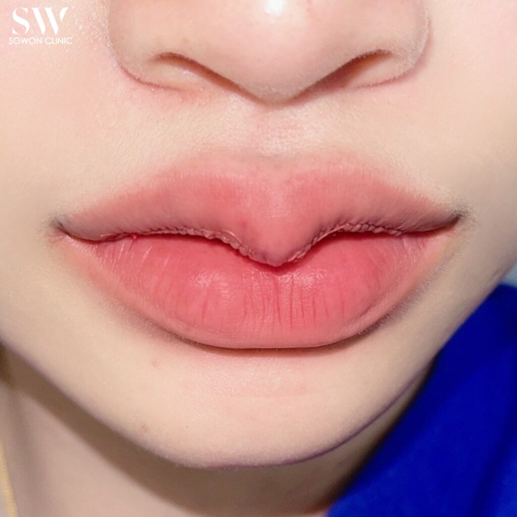 ฝีเย็บปากกระจับ 02