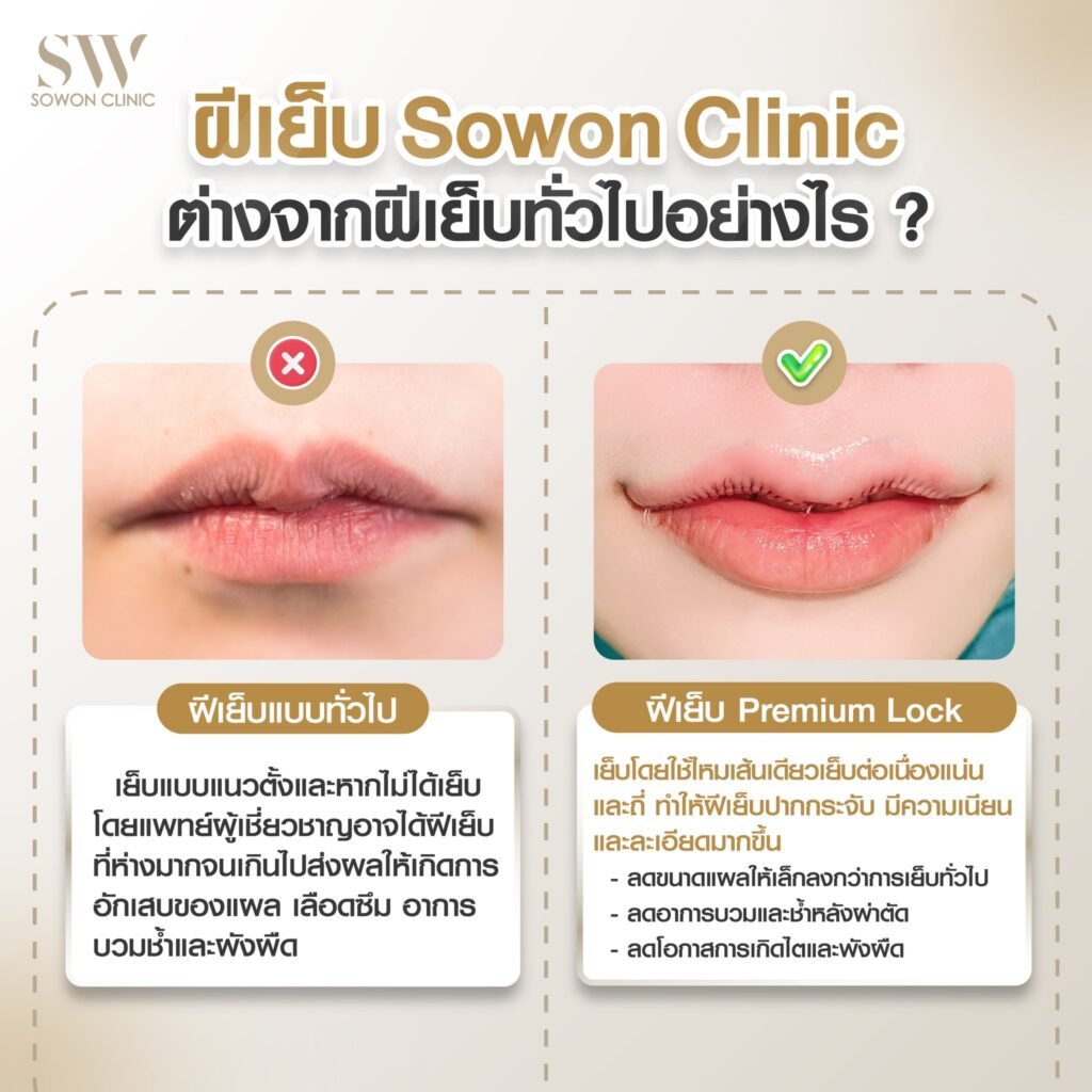 ฝีเย็บปากกระจับ 04