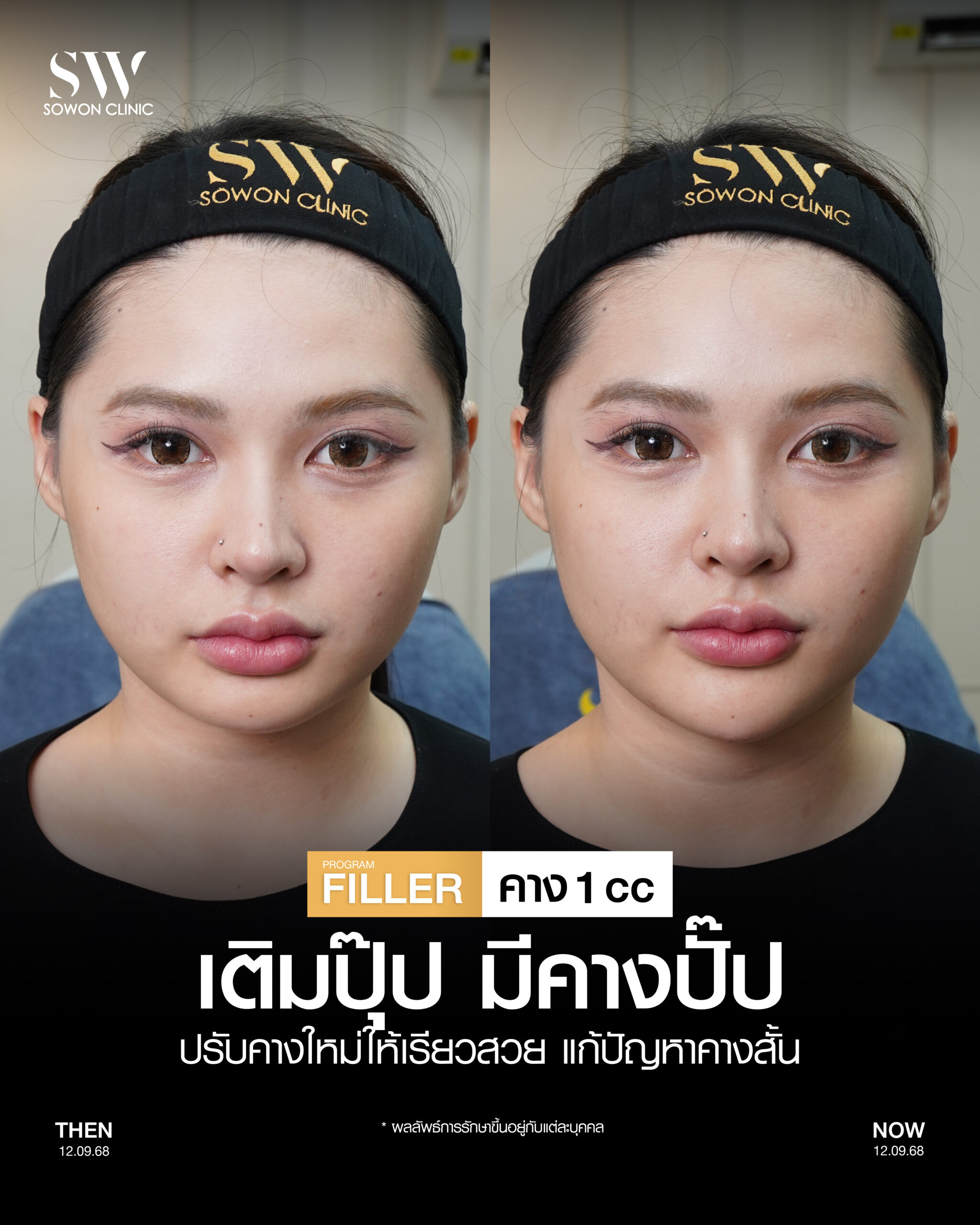 ฟิลเลอร์คาง 01