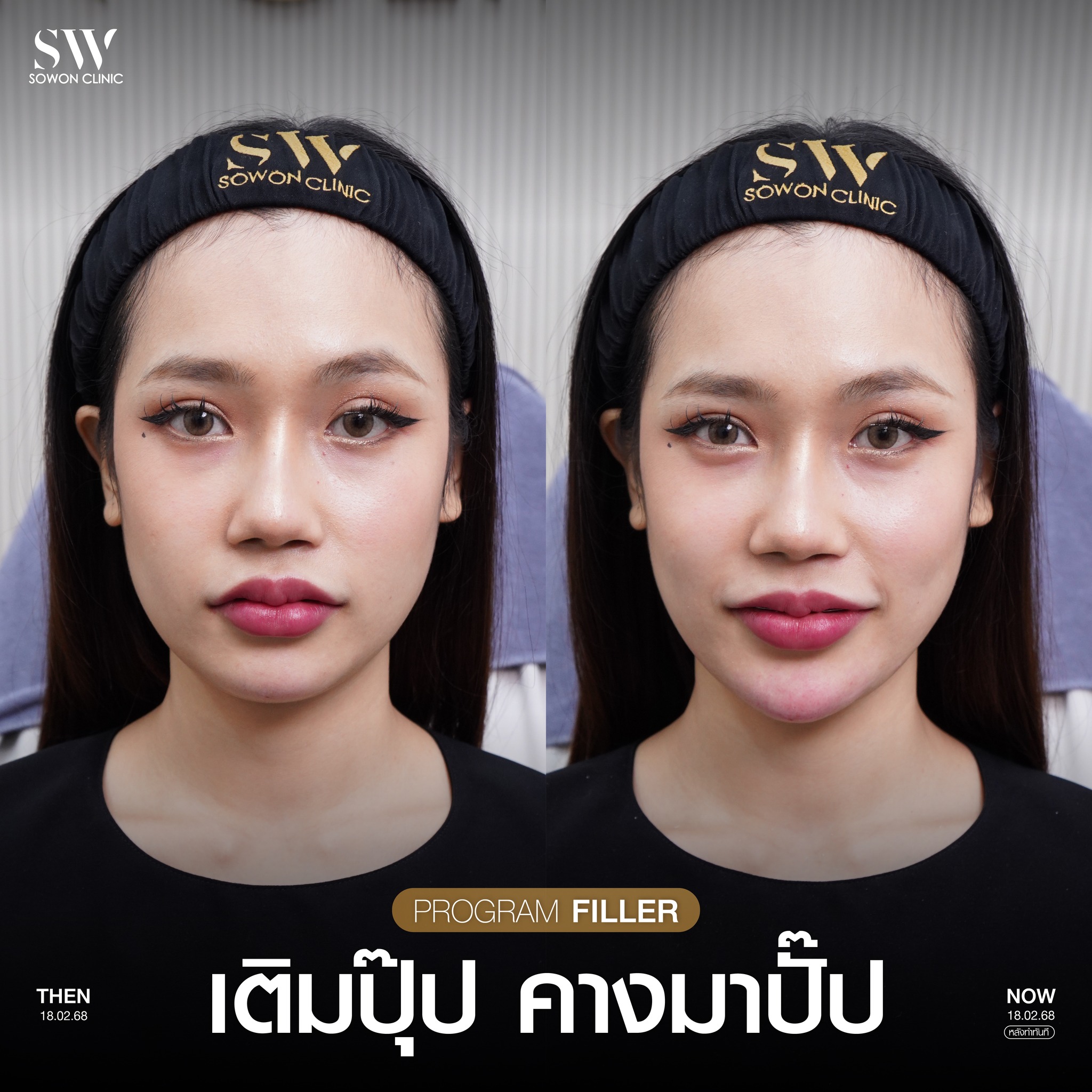 ฟิลเลอร์คาง 02