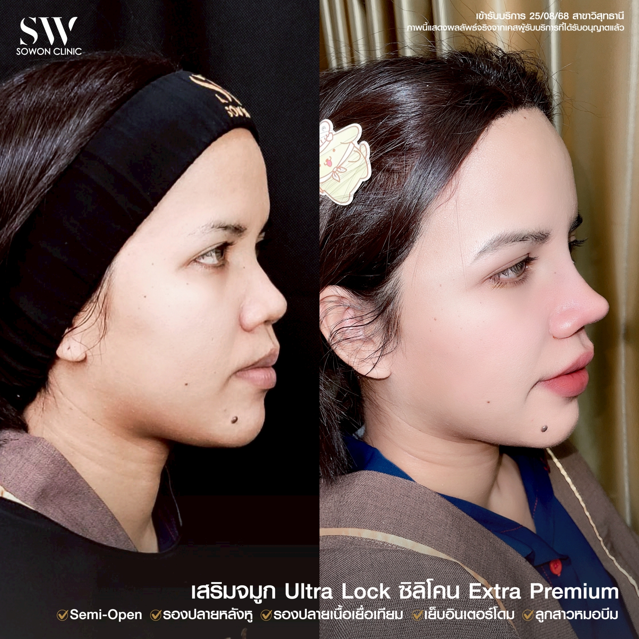 รีวิวเสริมจมูก 01