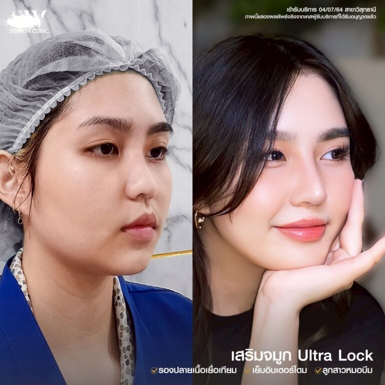 รีวิวเสริมจมูก 02