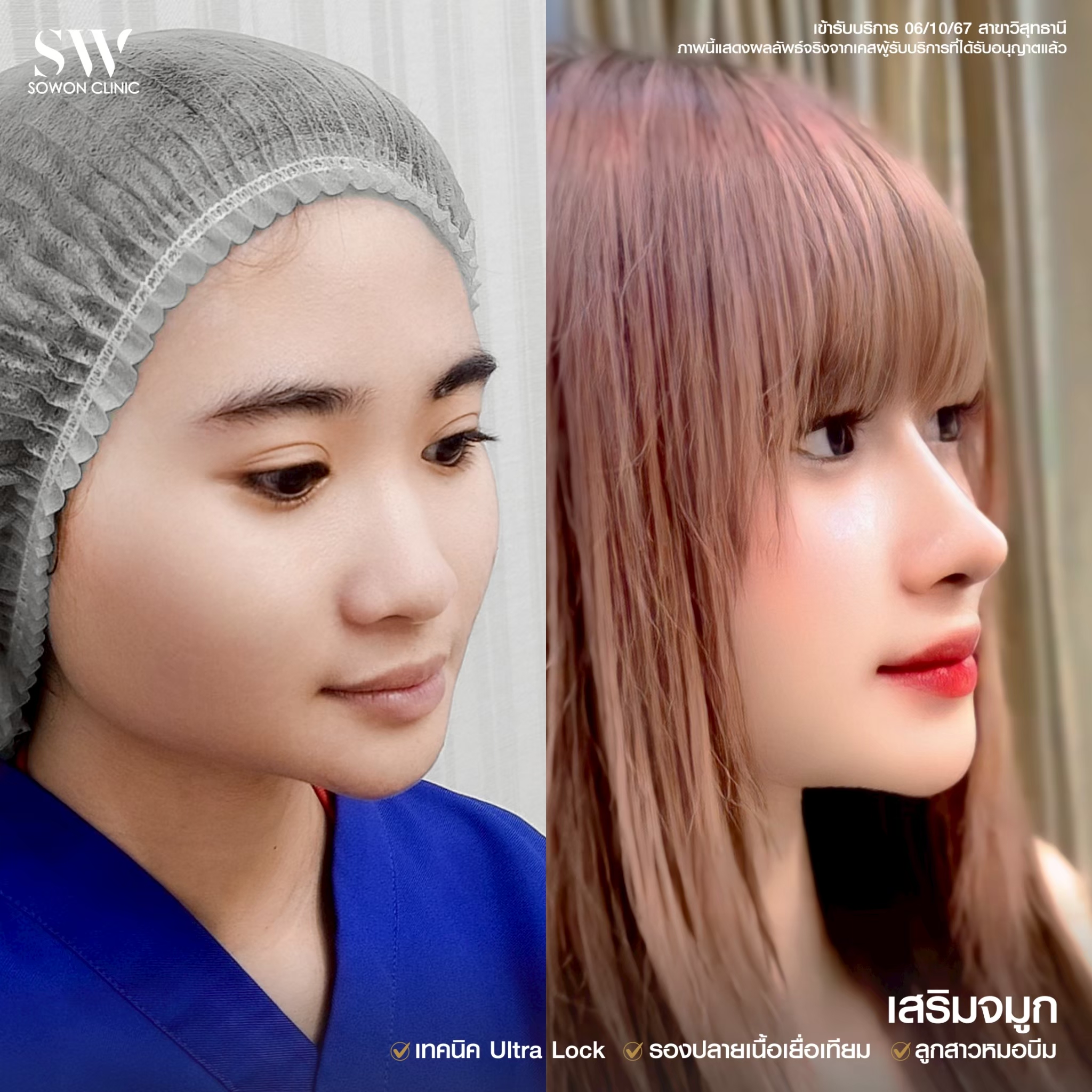 รีวิวเสริมจมูก 05