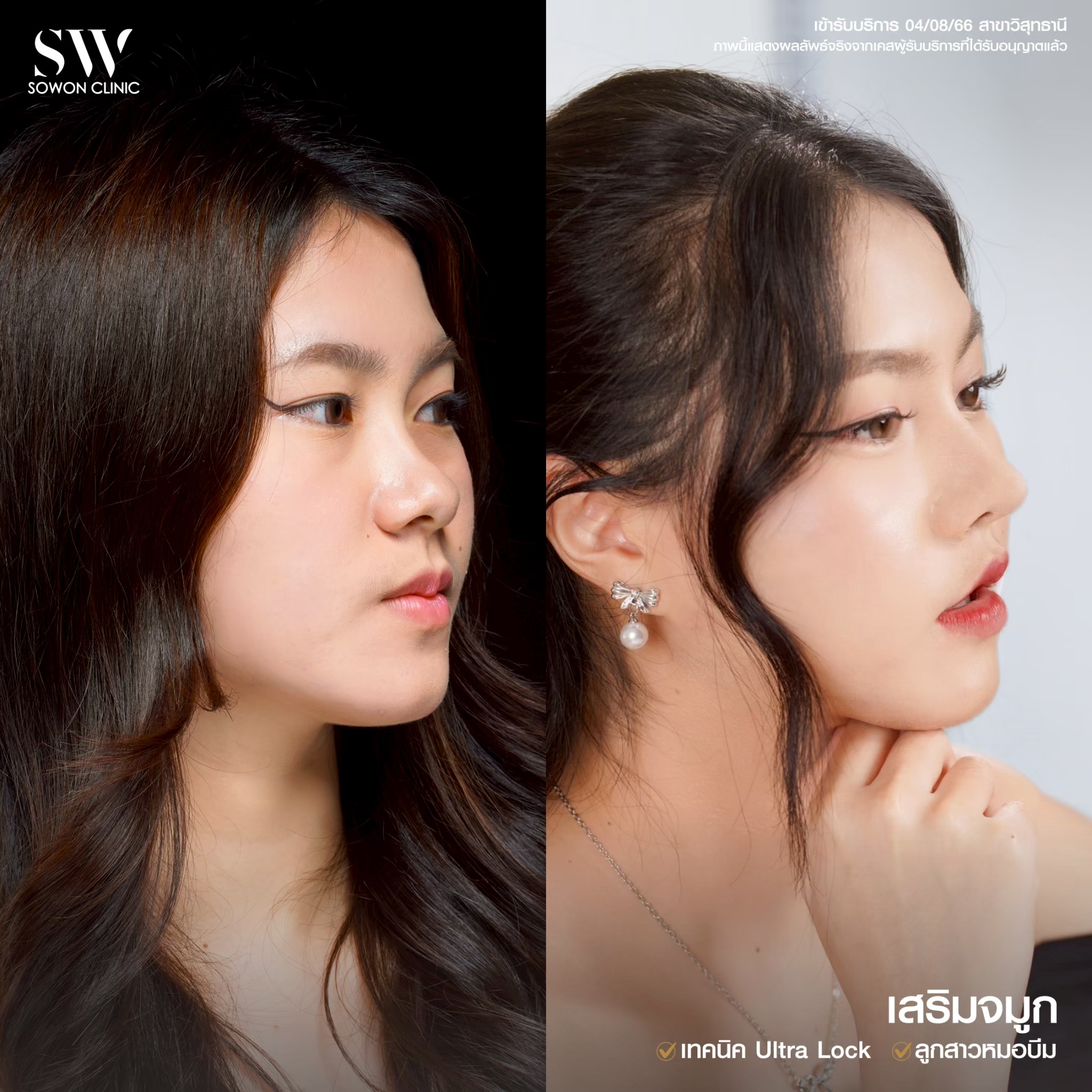 รีวิวเสริมจมูก 07