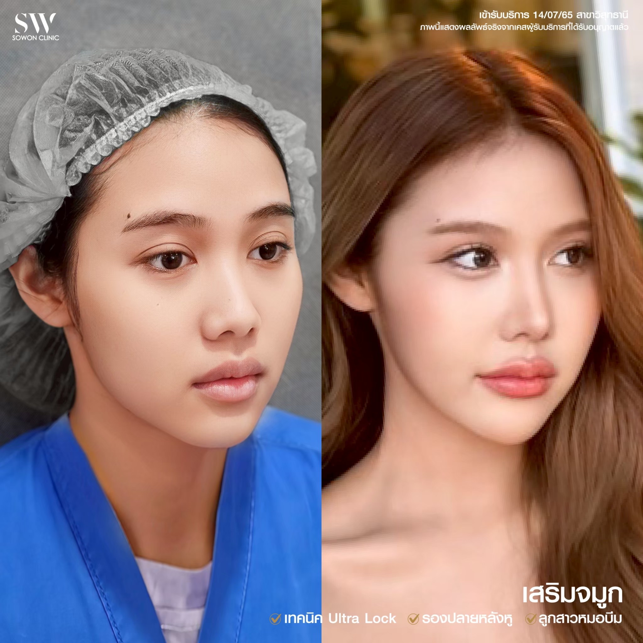 รีวิวเสริมจมูก 08