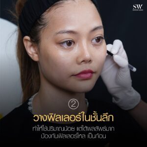 หมอปลอม เทคนิคที่ 2 การวางฟิลเลอร์ชั้นลึก