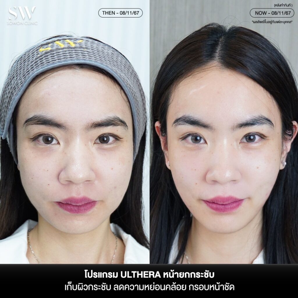 เผยหน้ายก กรอบหน้าชัด 03