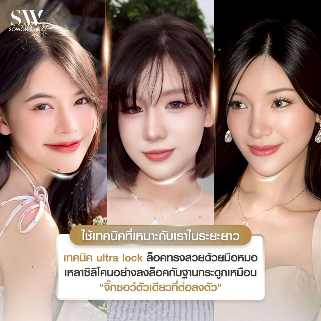 เสริมคาง 02