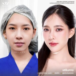 เสริมคาง 07