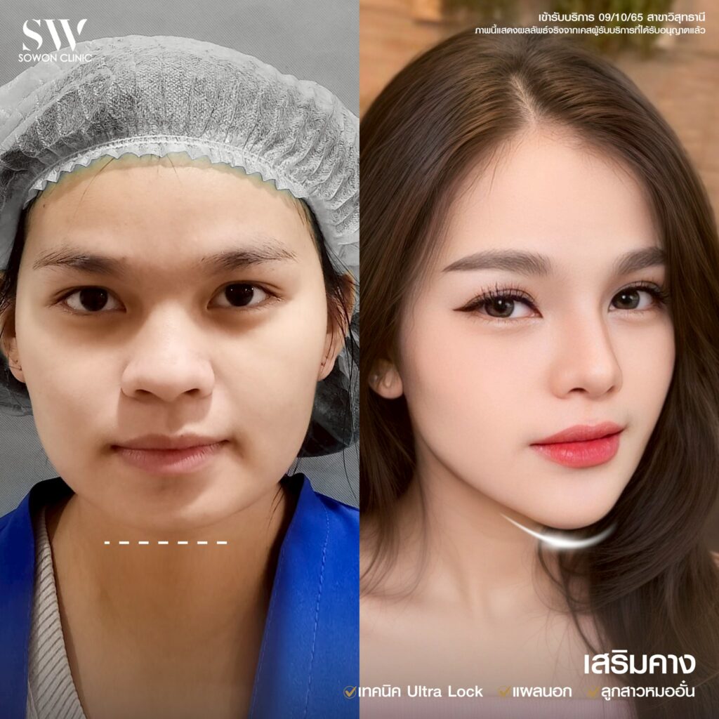เสริมคางหน้าเปลี่ยนไหม 01