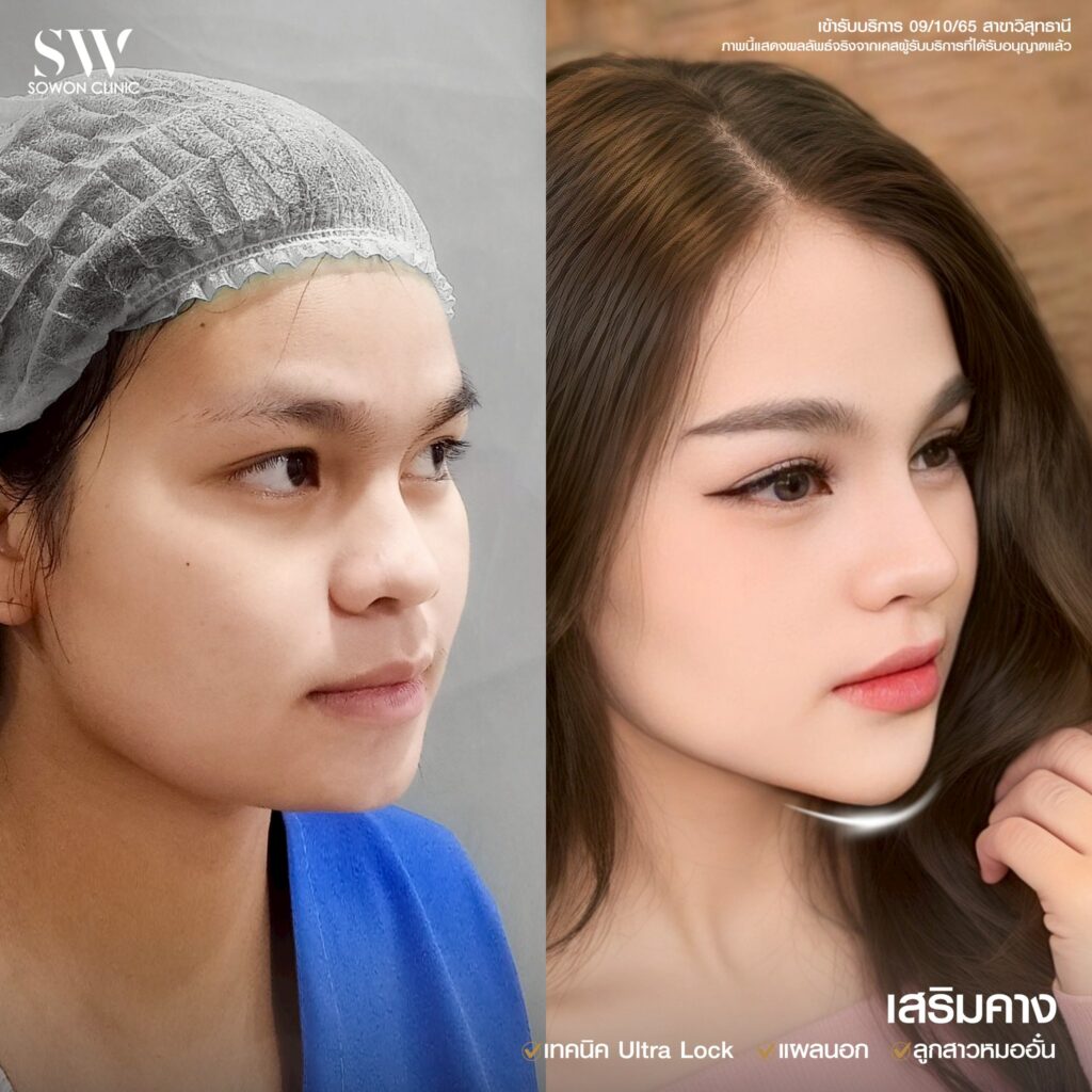 เสริมคางหน้าเปลี่ยนไหม 02