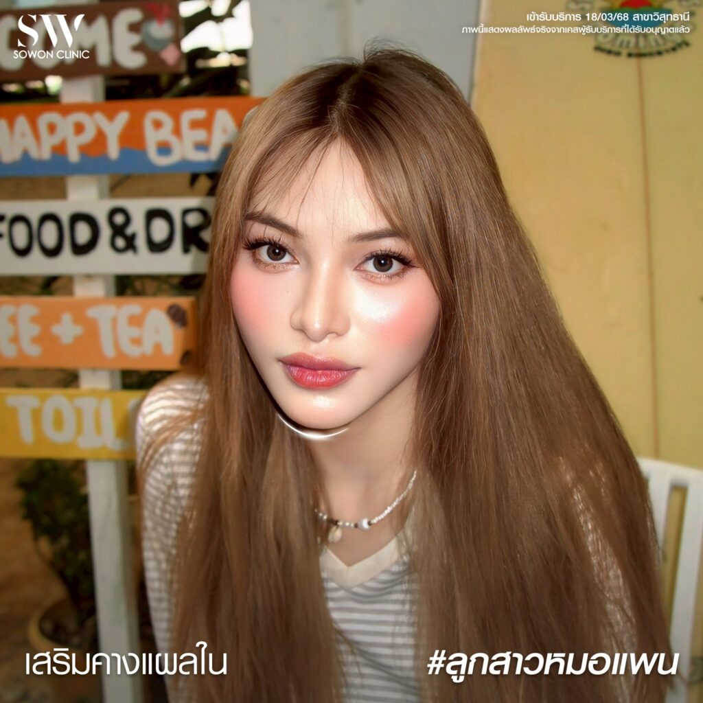 เสริมคางแผลใน 02