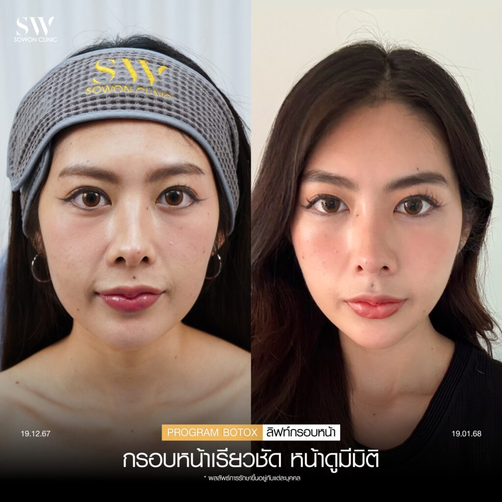 โบลิฟท์กรอบหน้า 01