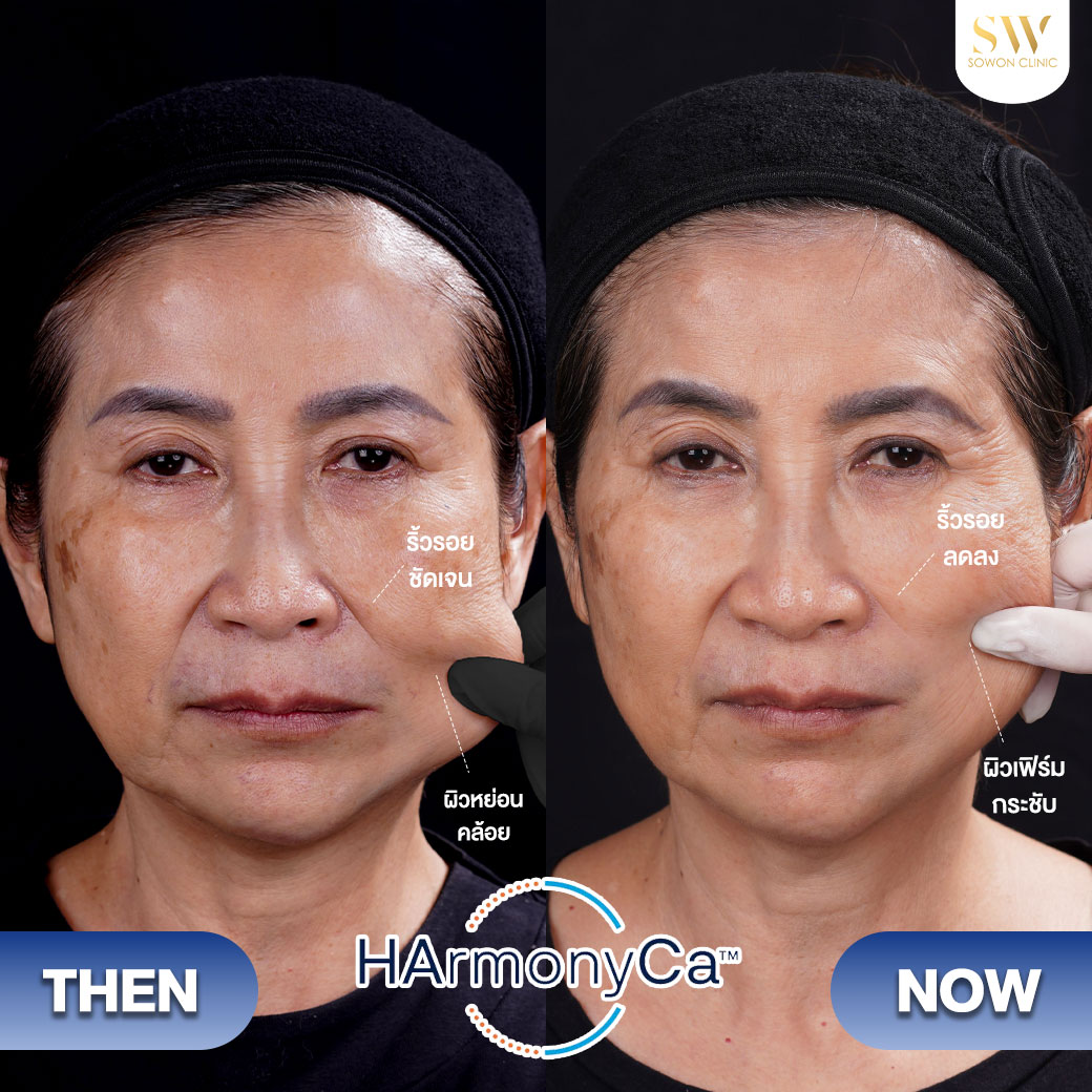 ยกกระชับ HMNC Case01