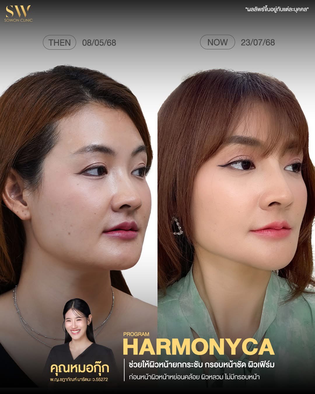 ยกกระชับ HMNC Case03