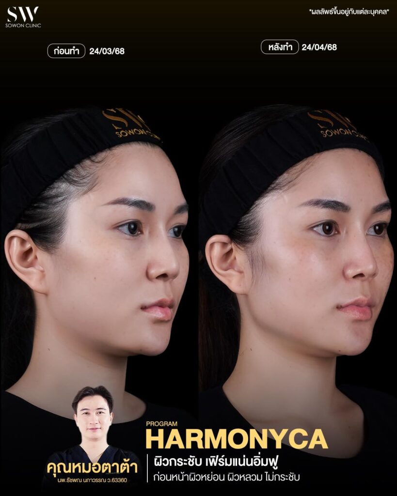 ยกกระชับ HMNC Case