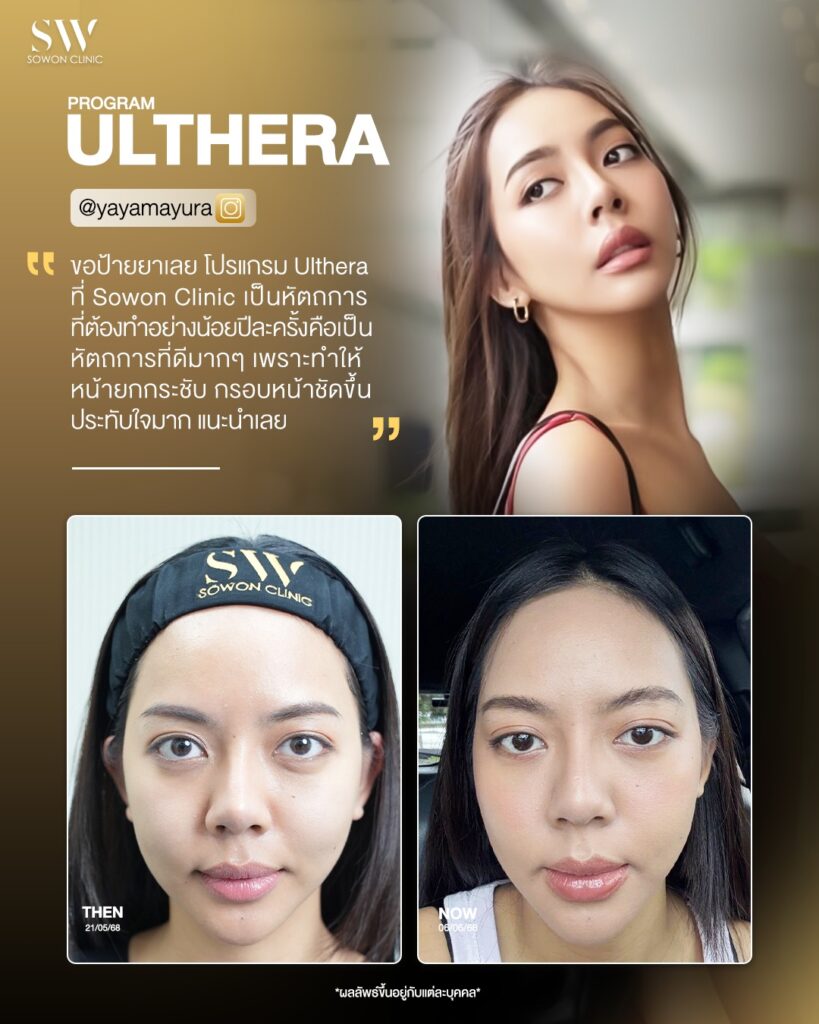 Ulthera 6