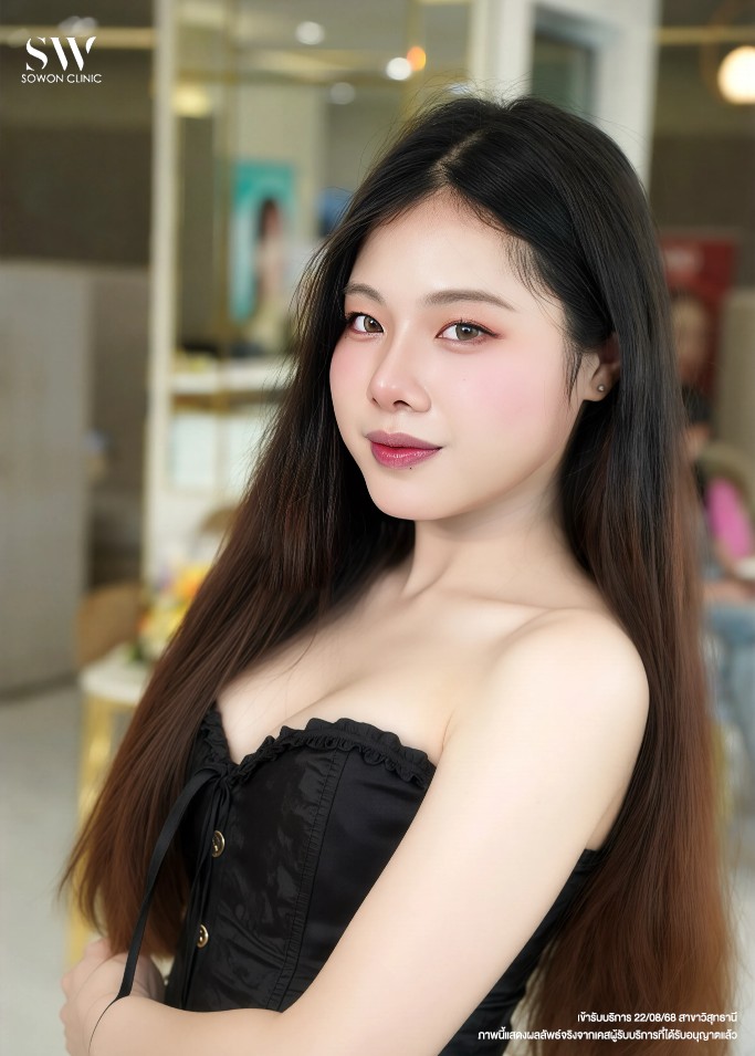 ทรงจมูกสโลปปลายพุ่ง หลังทำ