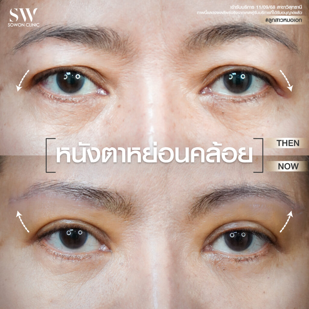 ยกคิ้ว ปัญหาหนังตาหย่อนคล้อย