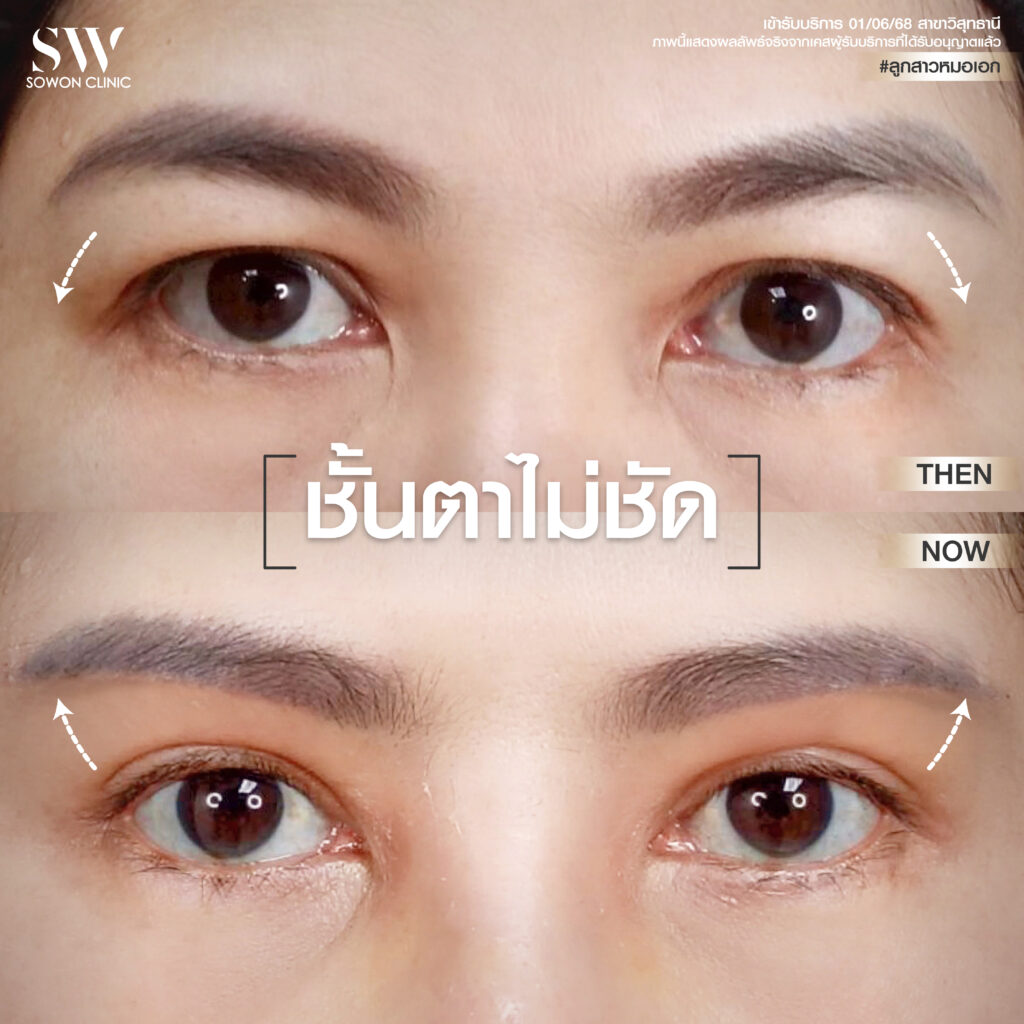 ยกคิ้ว ปัญหาชั้นตาไม่ชัด