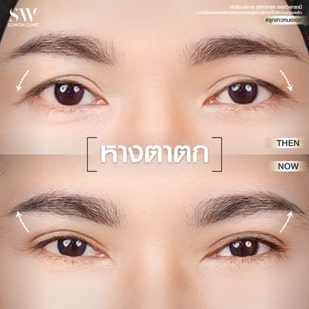 ยกคิ้ว ปัญหาหางตาตก