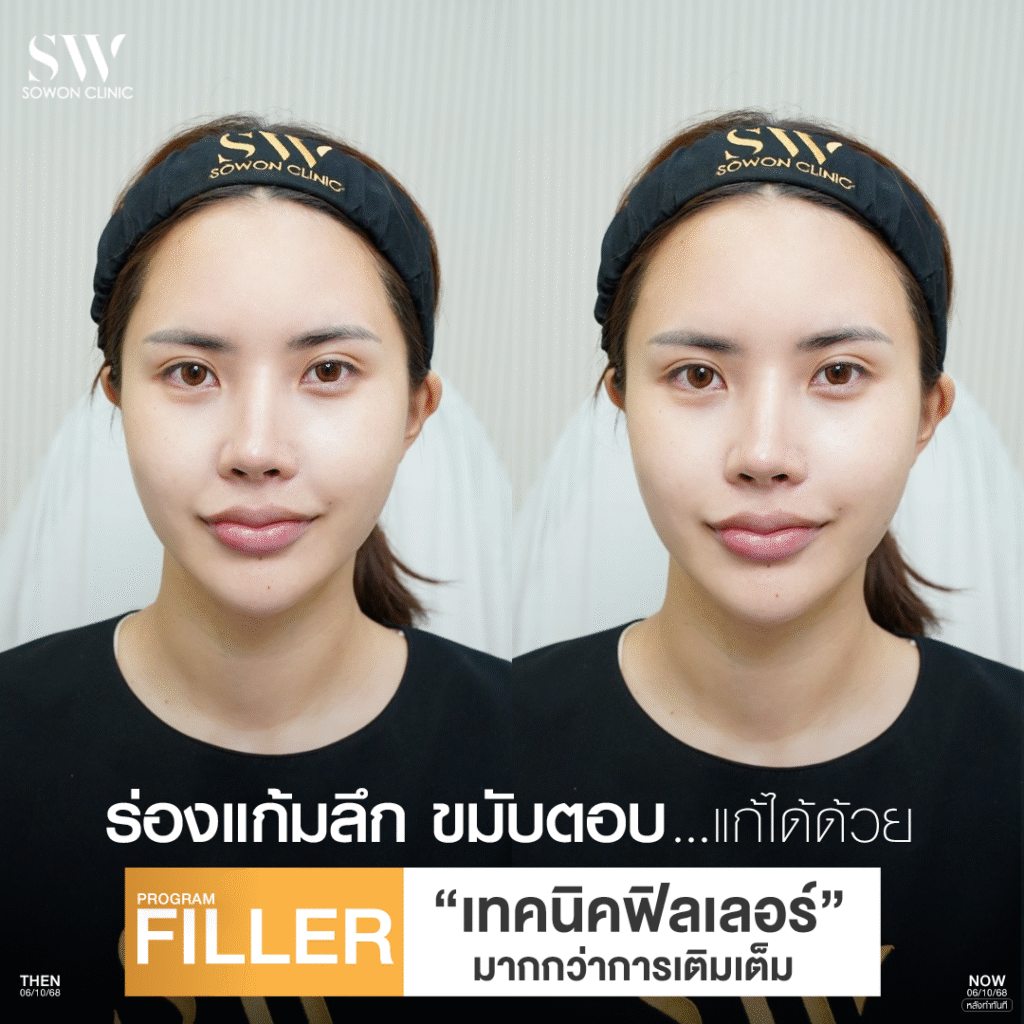 รีวิวฉีดร่องแก้ม ก่อนหลัง