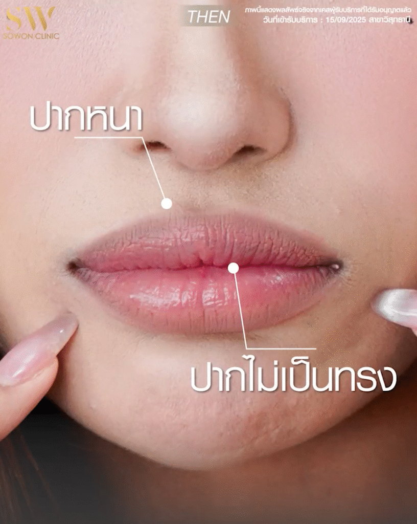 รีวิวปากกระจับ ปัญหาปาก