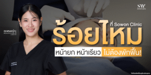 thread-lift-face-lift-no-downtime-skin-thread-knowledge