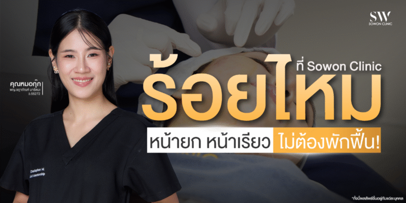 thread-lift-face-lift-no-downtime-skin-thread-knowledge