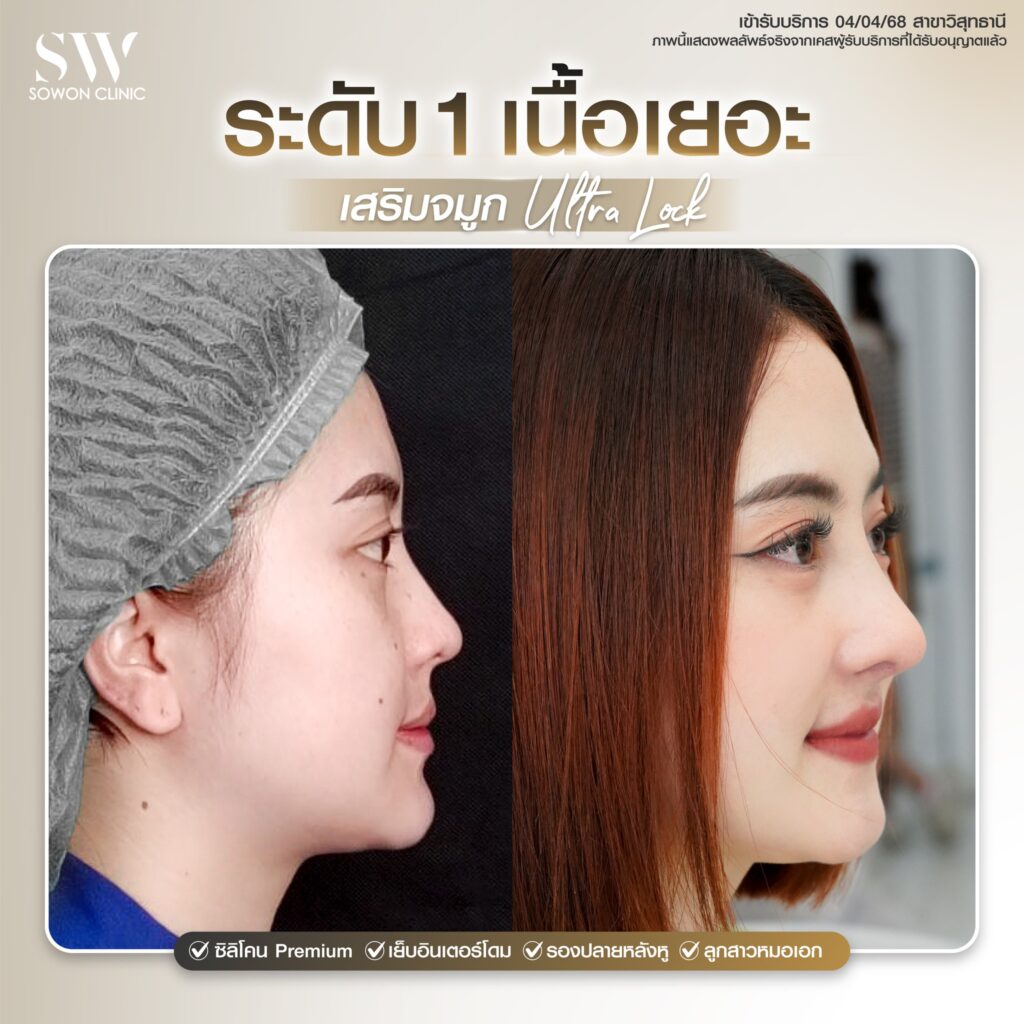ทรงจมูกสโลปปลายพุ่ง เนื้อจมูก1