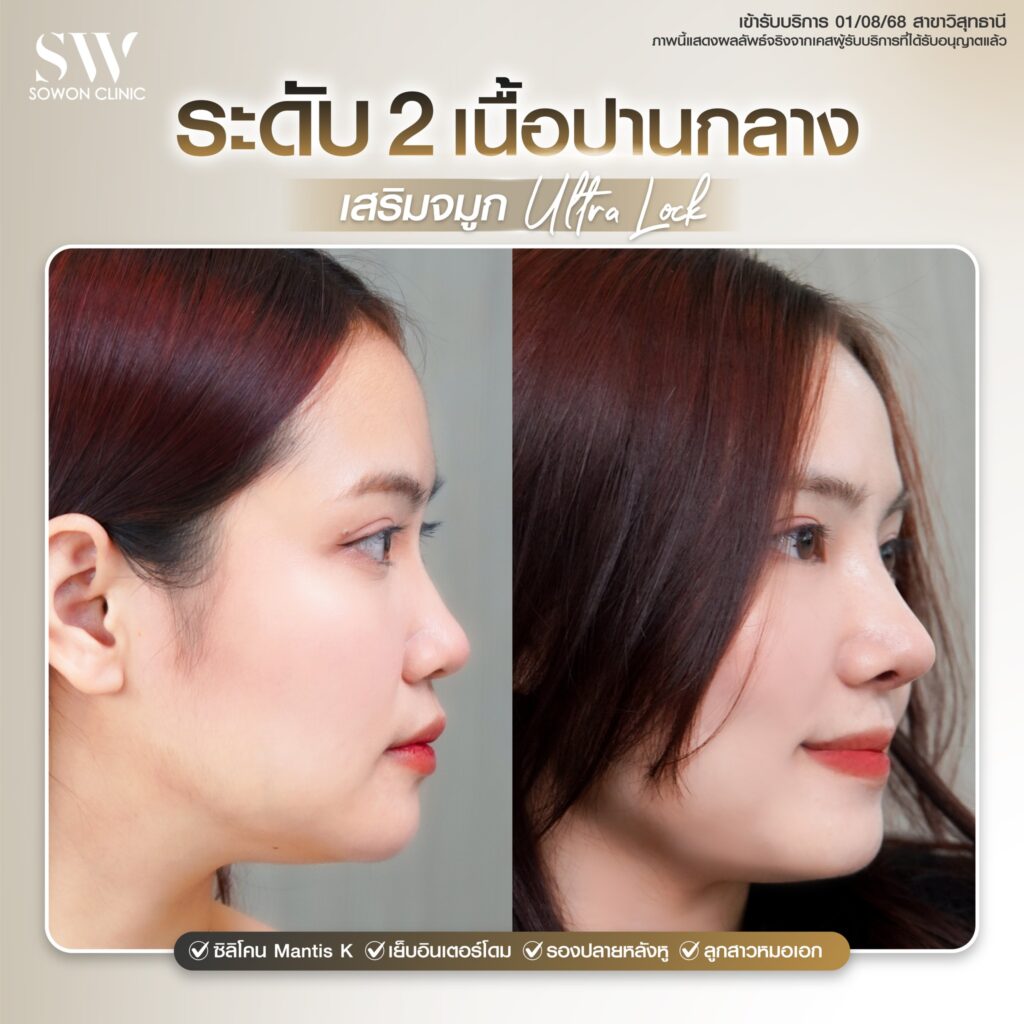 ทรงจมูกสโลปปลายพุ่ง เนื้อจมูก2