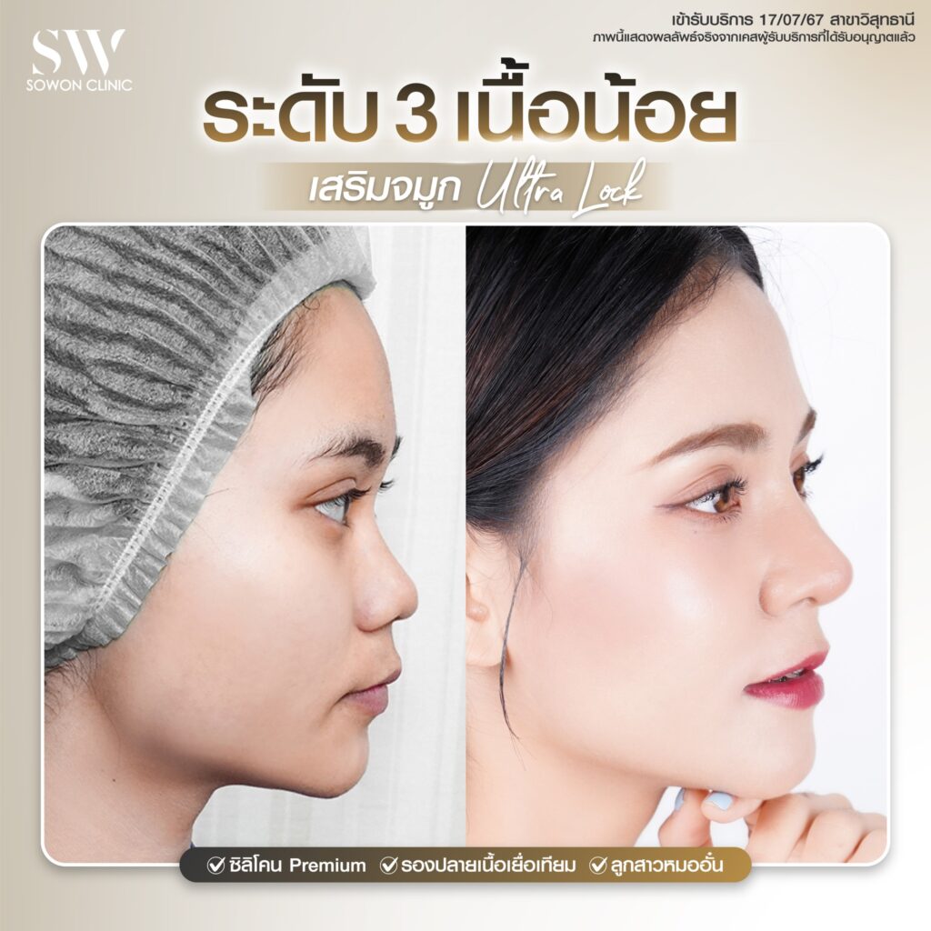 ทรงจมูกสโลปปลายพุ่ง เนื้อจมูก3