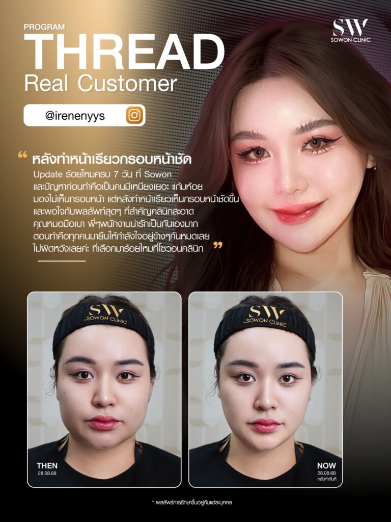 ยกกระชับหน้า_ผลลัพธ์หลังทำ