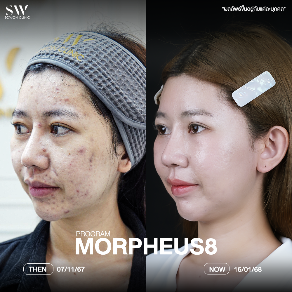 ยกกระชับหน้า รูปรีวิว-พราว-2