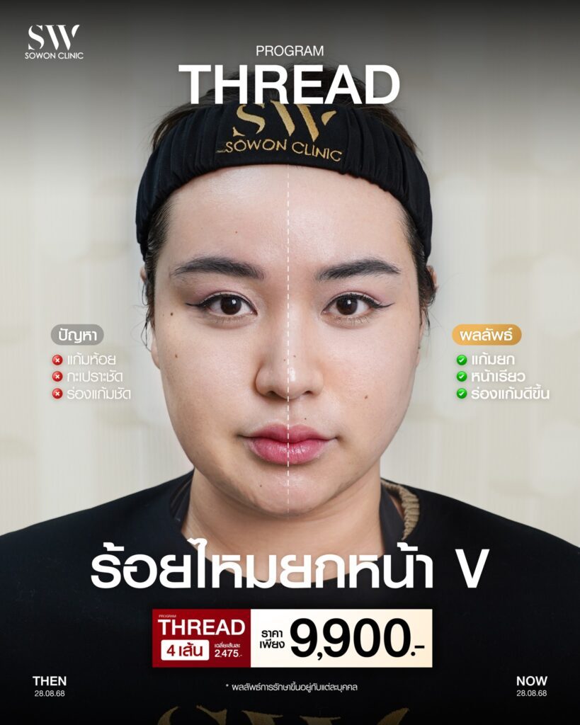 ยกกระชับหน้า ร้อยไหม