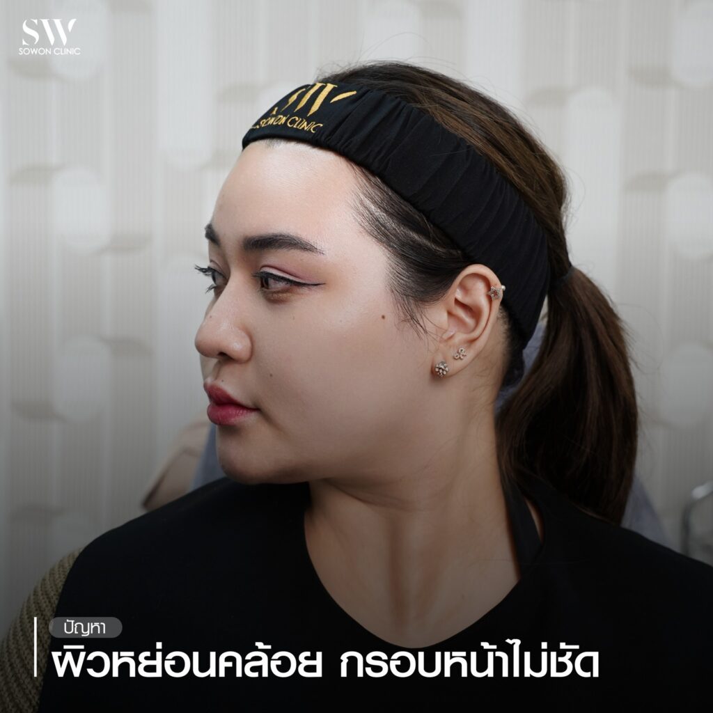 ยกกระชับหน้า ปัญหาหน้า