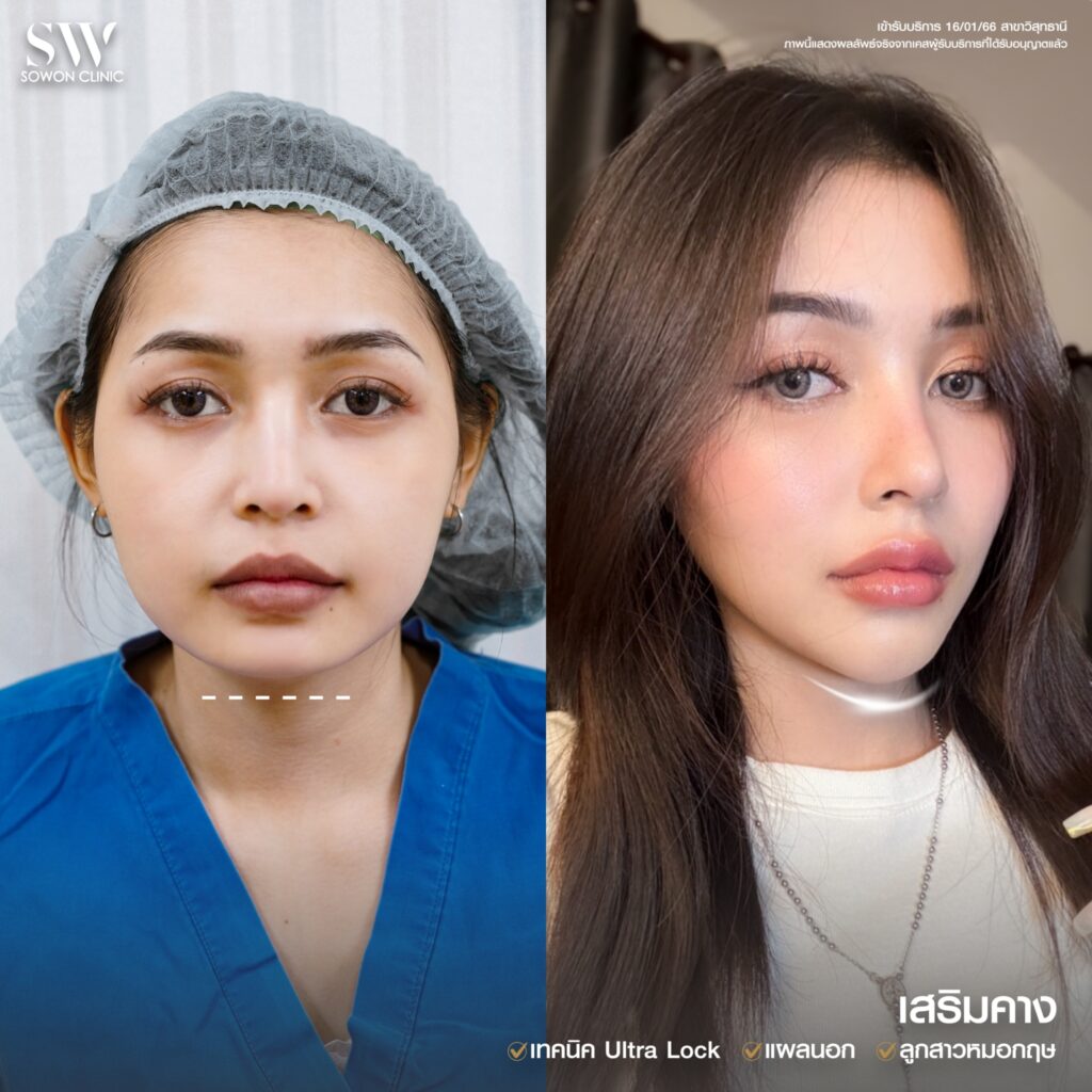 รีวิว เสริมคาง 02