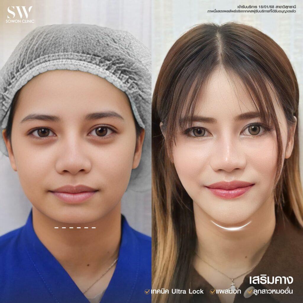 รีวิว เสริมคาง 03