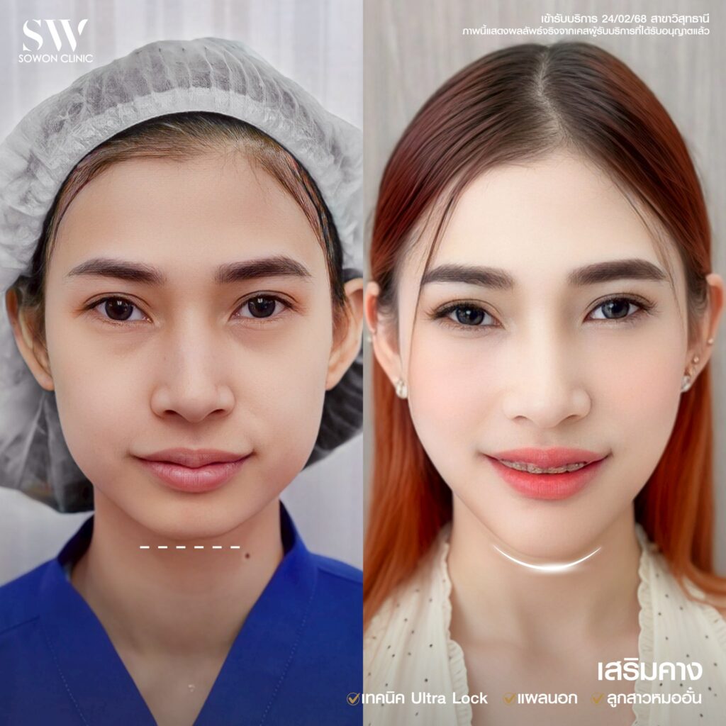 รีวิว เสริมคาง 04