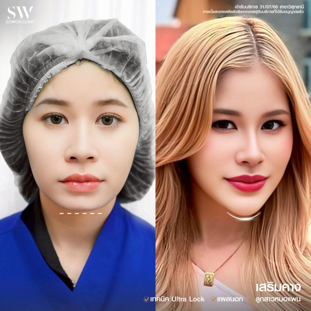 รีวิว เสริมคาง 05