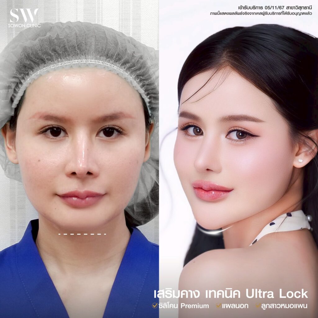 รีวิว เสริมคาง 06