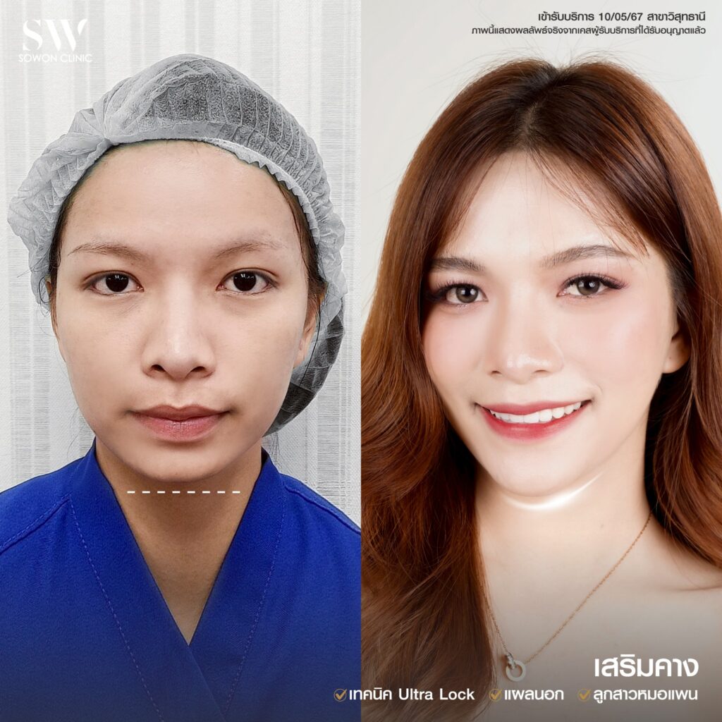 รีวิว เสริมคาง 07