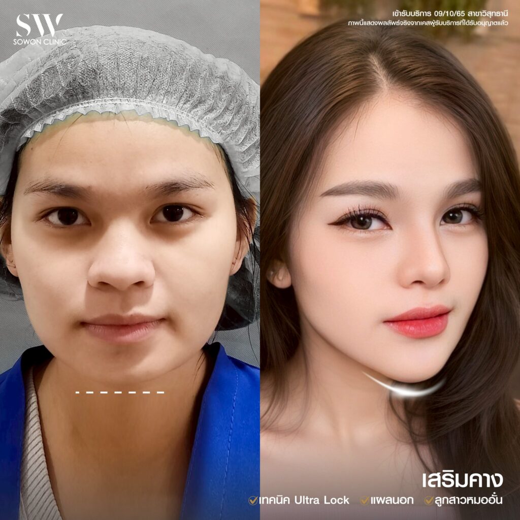 รีวิว เสริมคาง 08