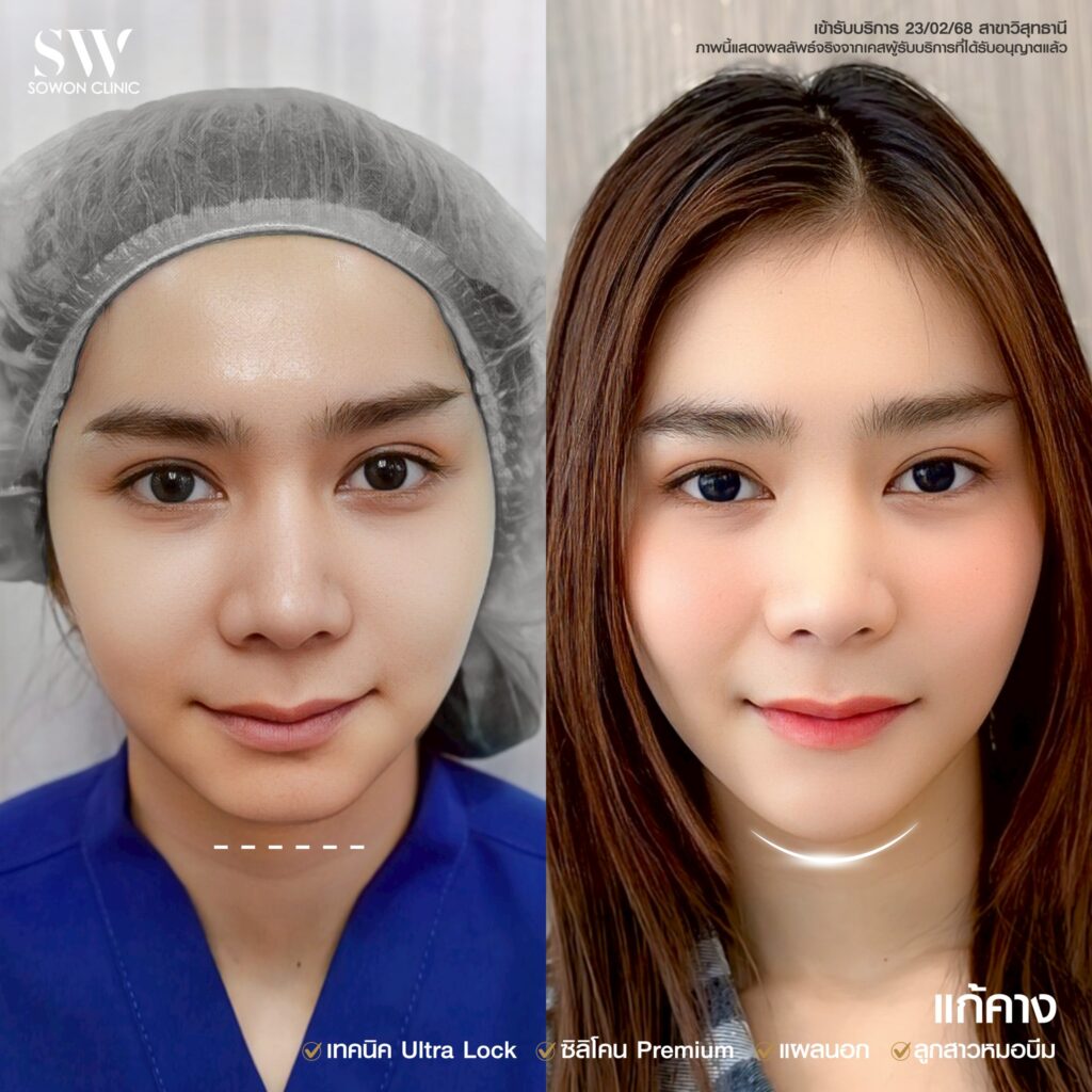 รีวิว เสริมคาง 09