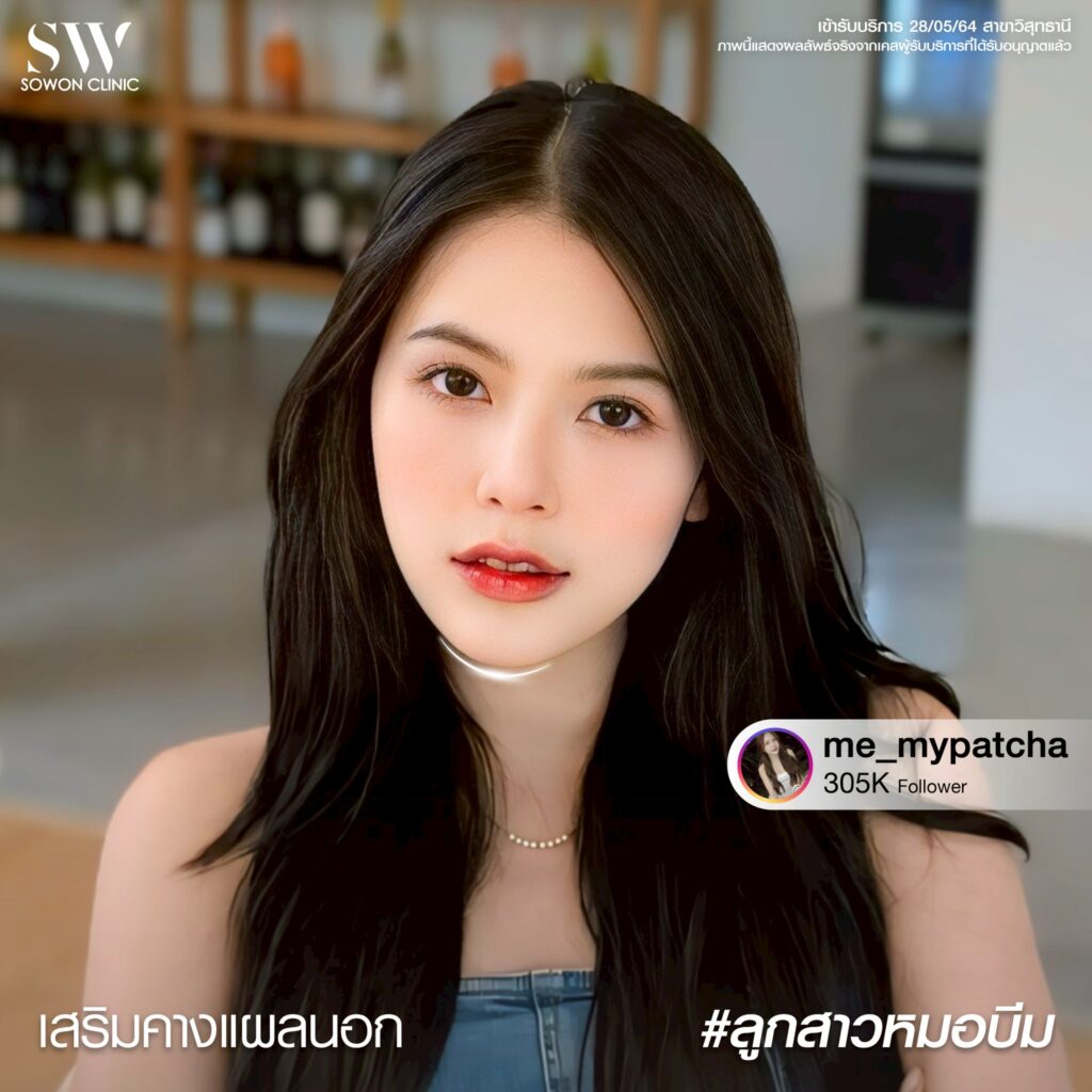 รีวิว เสริมคาง 1