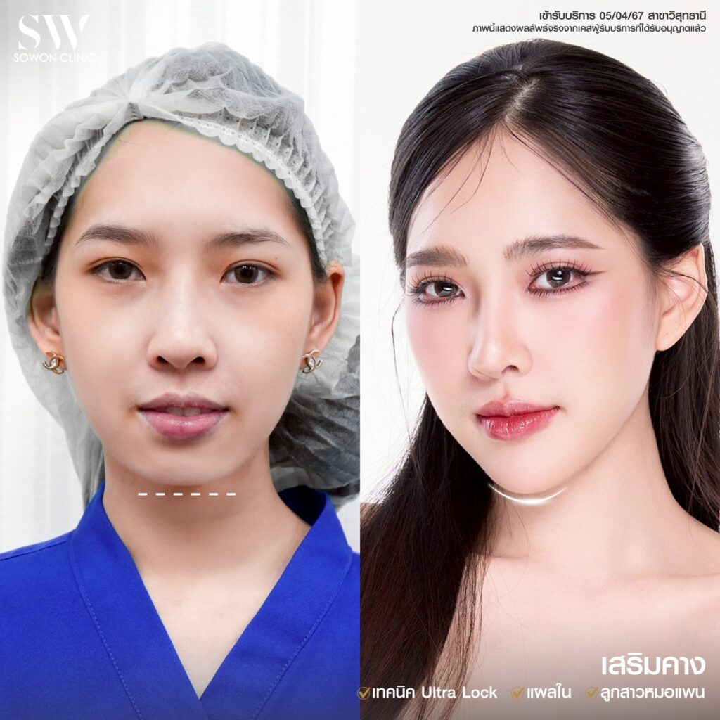 รีวิว เสริมคาง 10