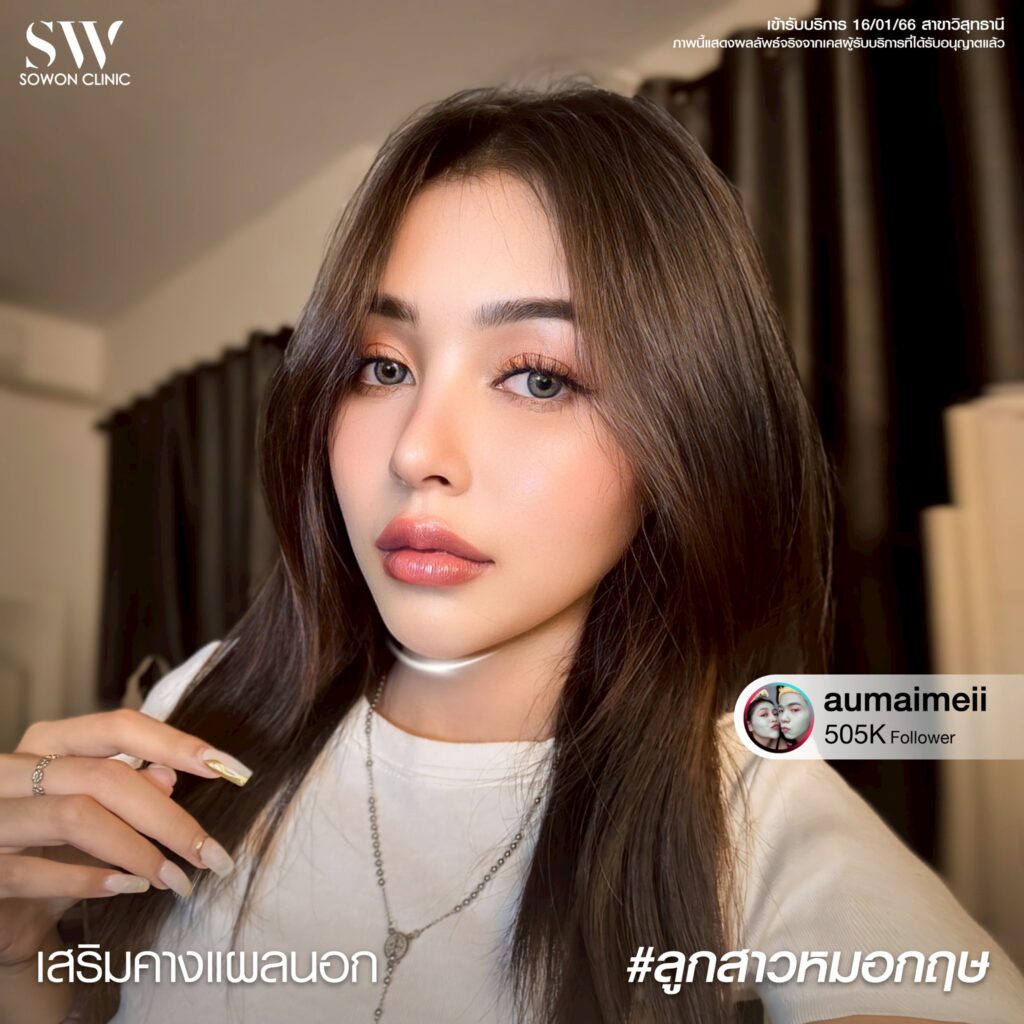 รีวิว เสริมคาง 2
