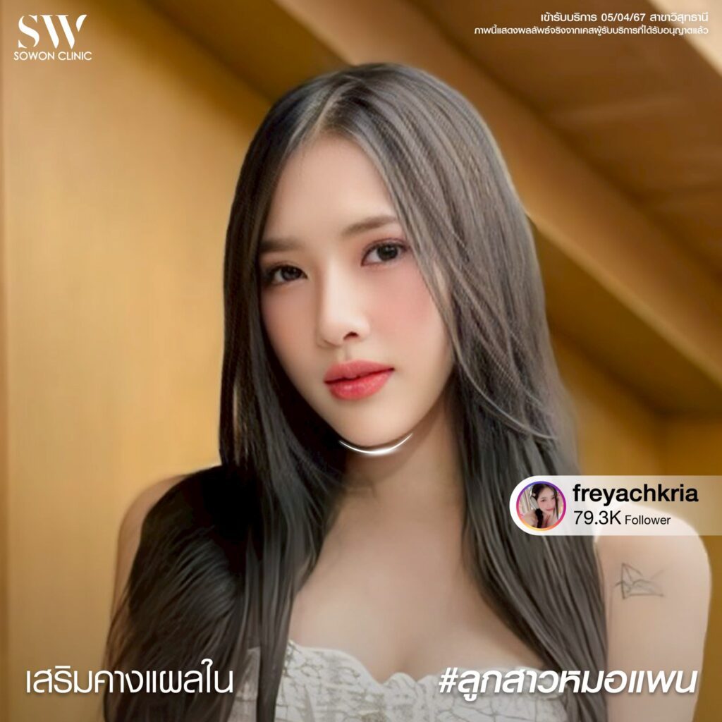 รีวิว เสริมคาง 3