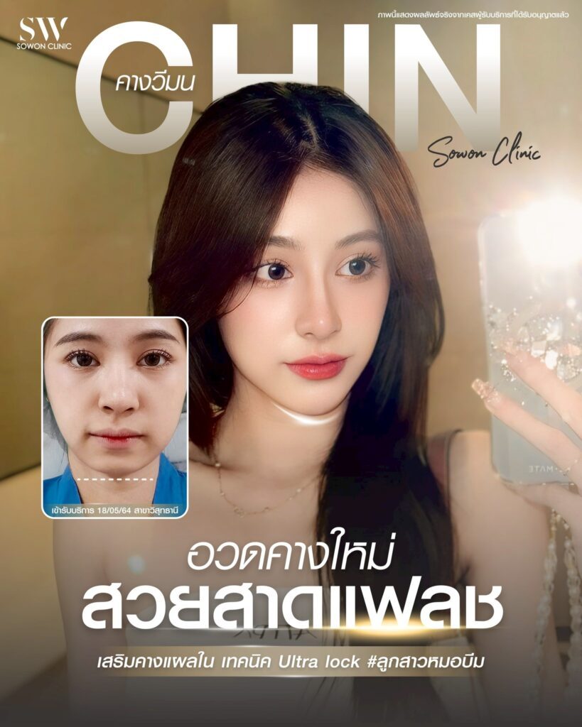รีวิว เสริมคาง