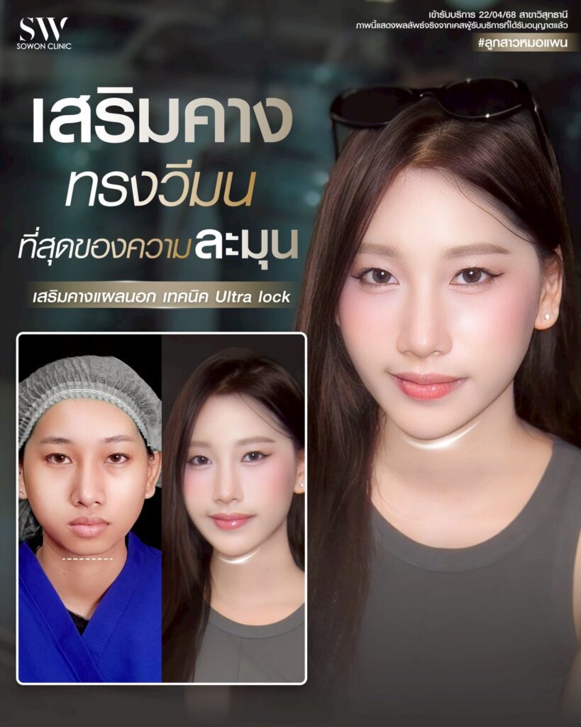 เสริมคาง 10